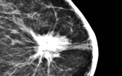 This Month’s View: Breast Cancer and Abbreviated MRI