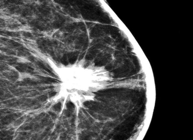 This Month’s View: Breast Cancer and Abbreviated MRI